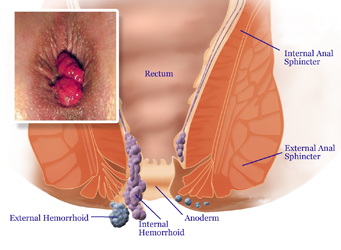 Piles Treatment in Modasa