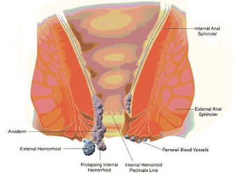 Piles Treatment in Modasa