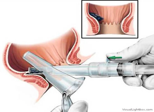 Piles Treatment in Modasa