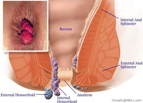 Fistula Treatment in Modasa